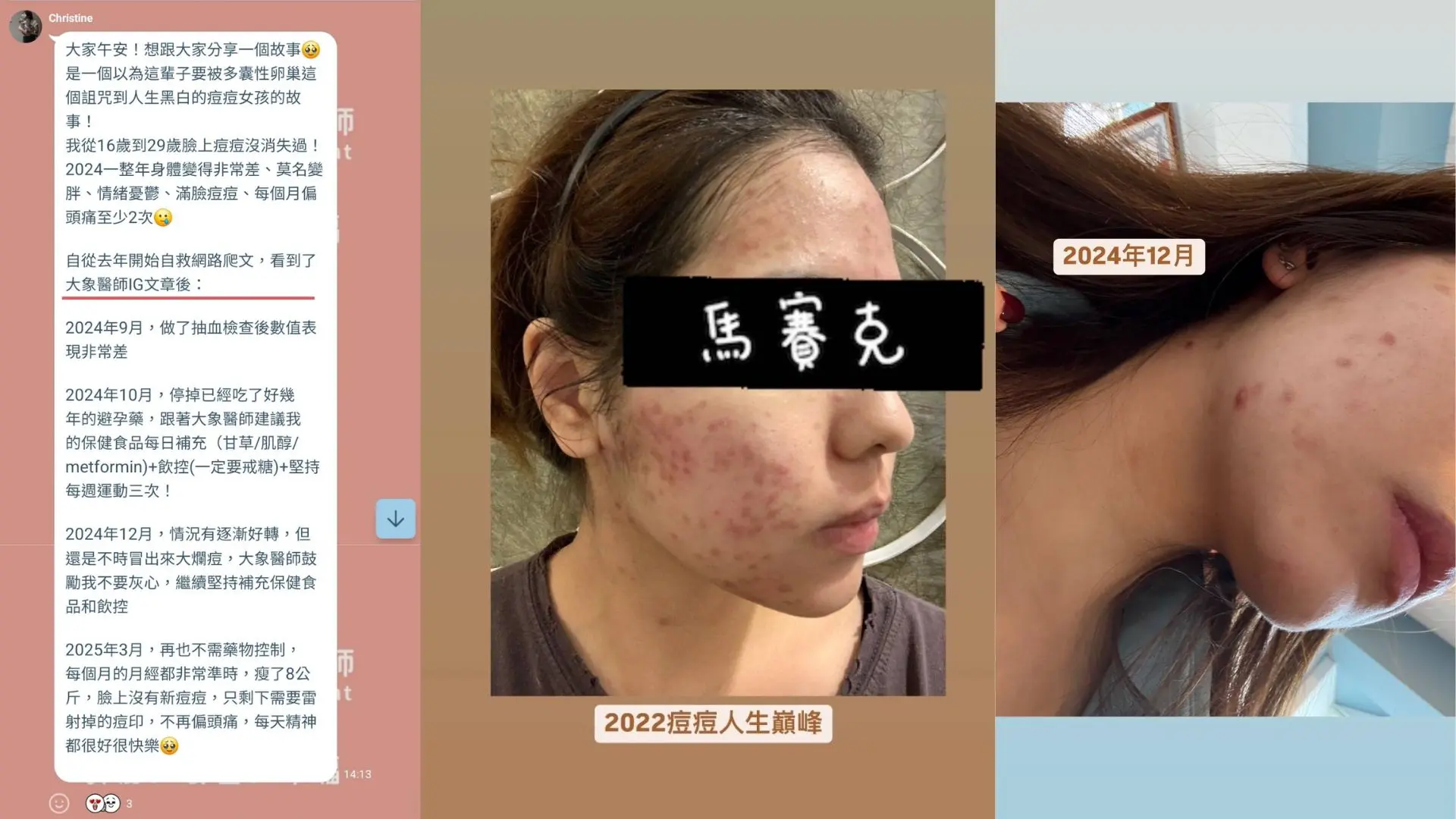 PCOS多囊性卵巢治療前