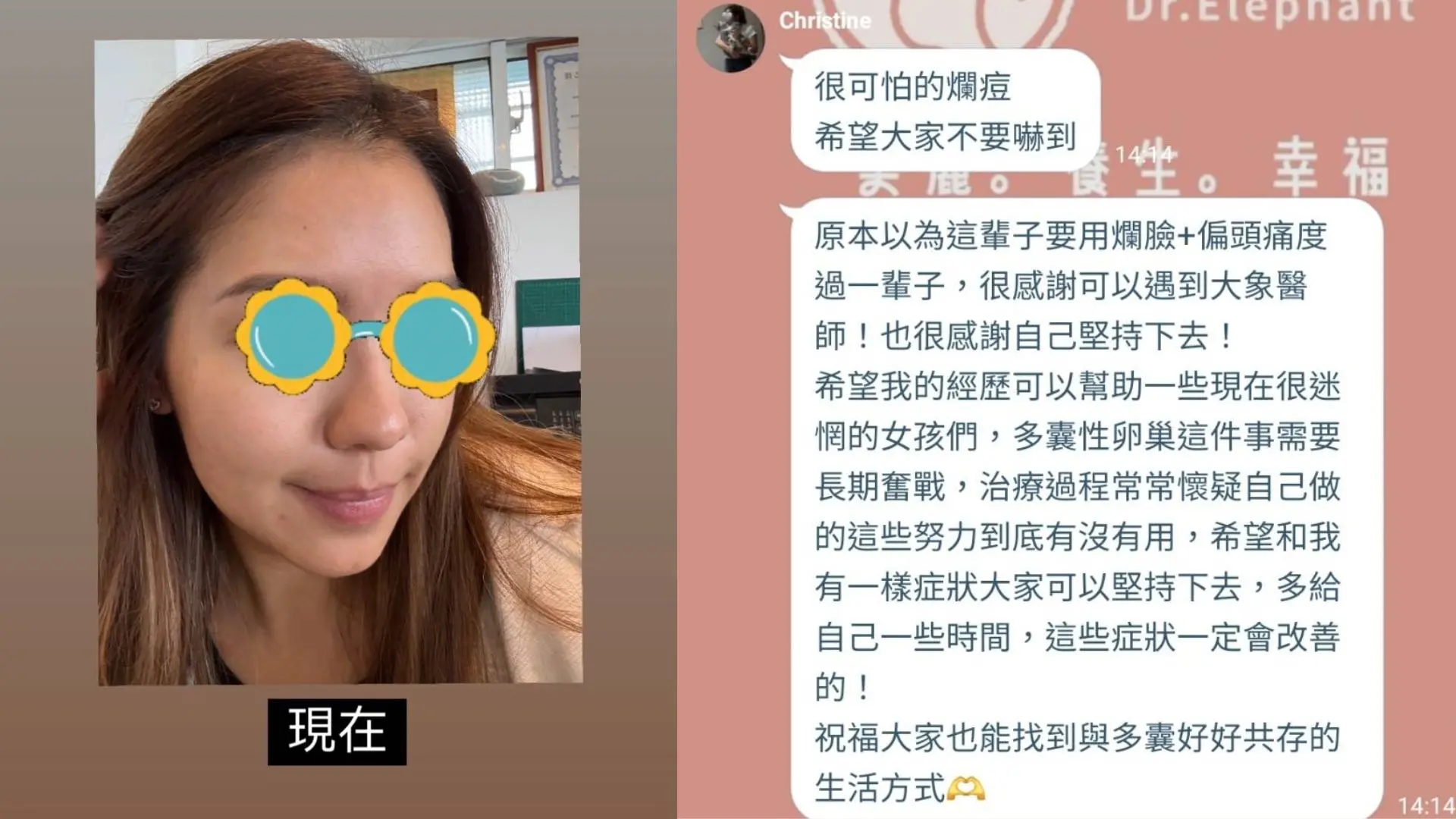 多囊性卵巢治療後